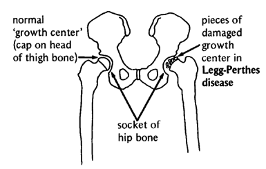 Socket of hip bone.