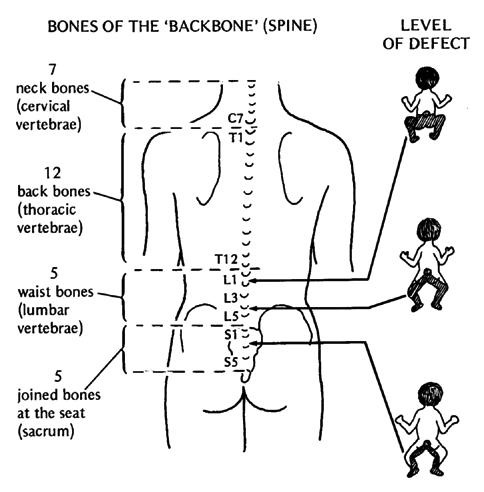 BONES OF THE 'BACKBONE' (SPINE) & LEVEL OF DEFECT