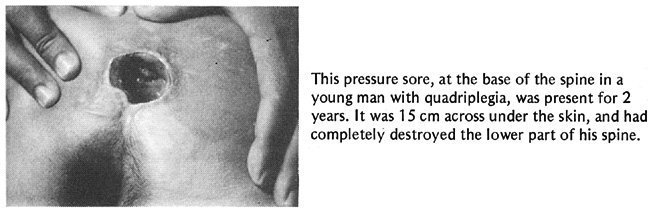 This pressure sore, at the base of the spine in a young man with quadriplegia, was present for 2 years.