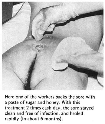 Here one of the workers packs the sore with a paste of sugar and honey.