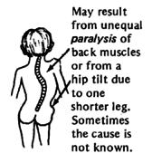 May result from unequal paralysis of back muscles or from a hip tilt due to one shorter leg. Sometimes the cause is not known.