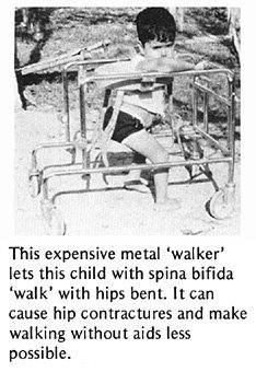 This expensive metal 'walker' lets this child with spina bifida 'walk' with hips bent. It can cause hip contractures and make walking without aids less possible.