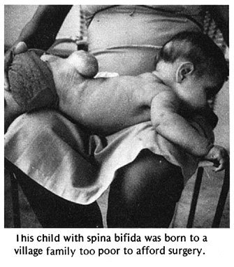 This child with spina bifida was born to a village family too poor to afford surgery.