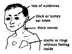 Loss of eyebrows & thick ear lobes, nerves & marks or rings without feeling inside.