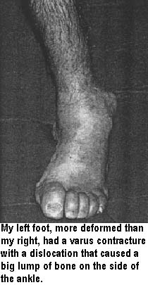 My left foot, more deformed than my right, had a varus contracture with a dislocation that caused a big lump of bone on the side of the ankle.