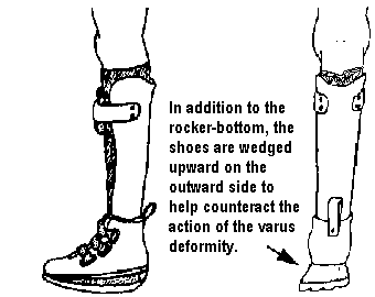 In addition to the rocker-bottom, the shoes are wedged upward on the outward side to help counteract the action of the varus deformity.